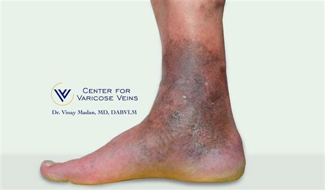 What Are The Complications Of Untreated Varicose Vein Disease Center