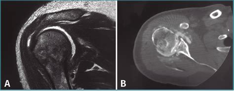 Luxación glenohumeral posterior aguda con gran inestabilidad