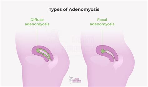 Adenomyosis Treatment Options Therapy Surgery And No Surgery