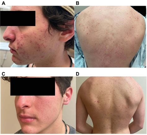 A And B Images Of Patient Before Acne Treatment C And D Improved