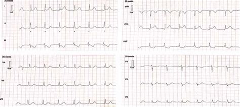 12-lead ECG highlighting ST-segment elevation in leads I and aVL ...