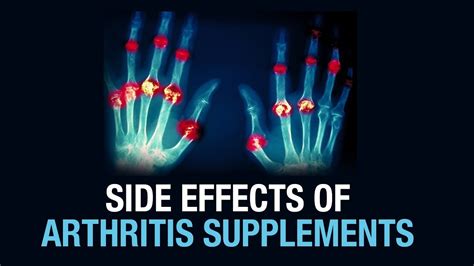 Side effects of Arthritis Supplements - Dr. Gaurav Sharma - Defeating ...