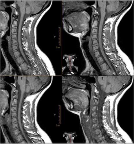 Spine Imaging Flashcards Quizlet