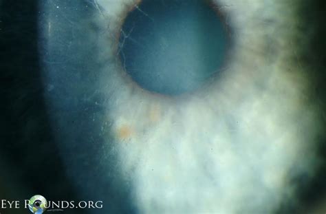 Atlas Entry - Lattice corneal dystrophy