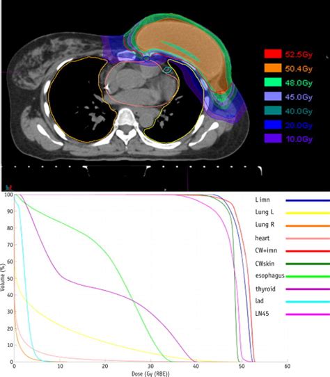 A Novel Approach To Postmastectomy Radiation Therapy Using Scanned