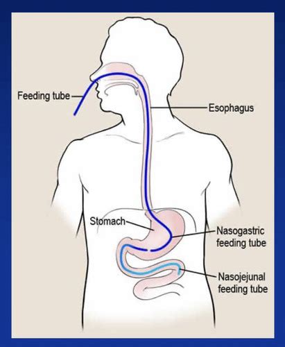 Enteral Nutrition Flashcards Quizlet