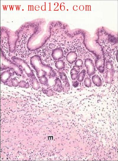 内科学图片库第四篇 消化系统疾病 慢性胃炎萎缩性胃炎粘膜变薄血管透见