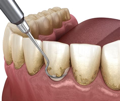 How To Remove Brown Stains From Teeth