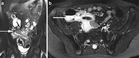 Acute Appendicitis With Appendicolith Mri In A 12 Year Old Girl With