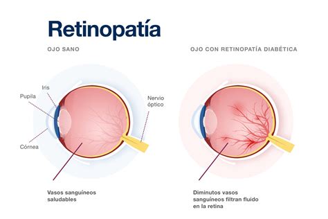 APEC RETINOPATÍA DIABÉTICA