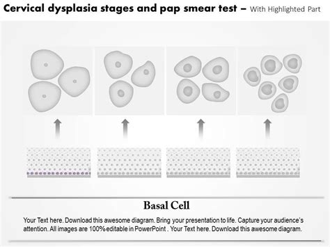 0814 Cervical Dysplasia Stages And Pap Smea Test Medical Images For