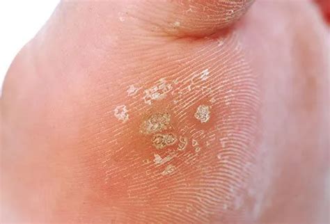 Types of Warts: Symptoms, Removal, and Treatment