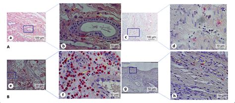 Immunohistochemical staining of mast cells and eosinophils in NPs. A... | Download Scientific ...