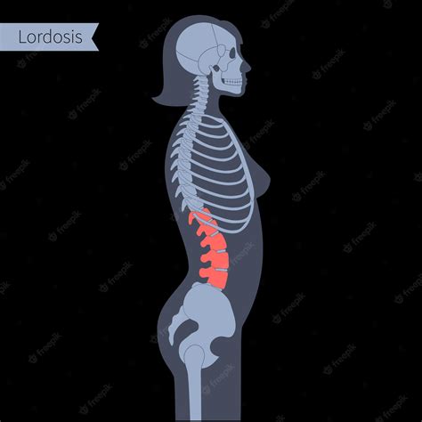 Lordosis Women