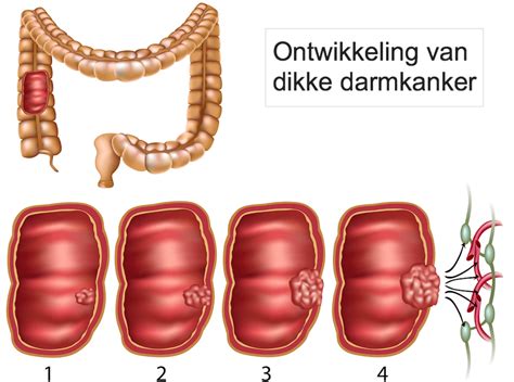 Darmkanker Darmgezondheid