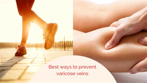 What Are The Best Exercises To Prevent Varicose Veins Dr Abhilash