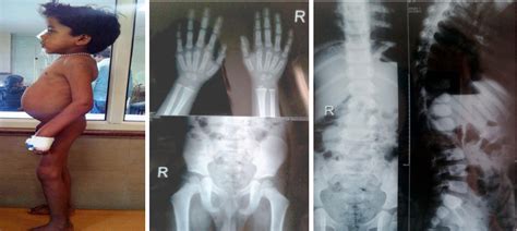 Figure From Mucopolysaccharidosis Type Ii Hunter Syndrome A