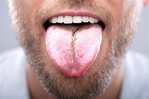 White Tongue Causes And Treatment Symptom Medicspark