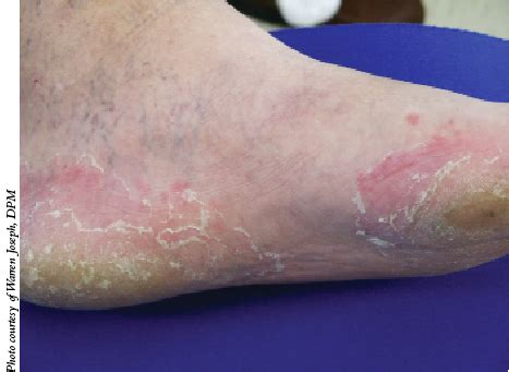 Athlete S Foot All About Tinea Pedis Watsonia Podiatry