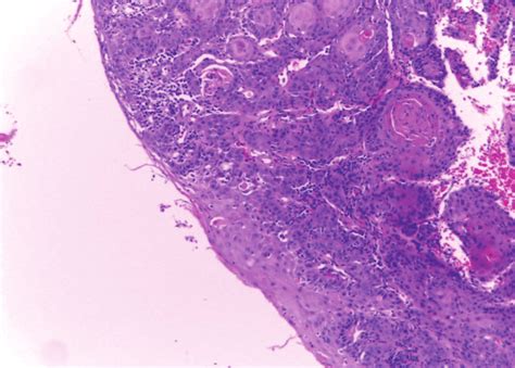 Carcinoma Oral De Células Escamosas Nidos Invasivos De Tumor Rodeados Download Scientific