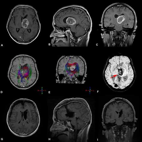 Preoperative And Postoperative Imaging Of Thalamic Malignant Tumor