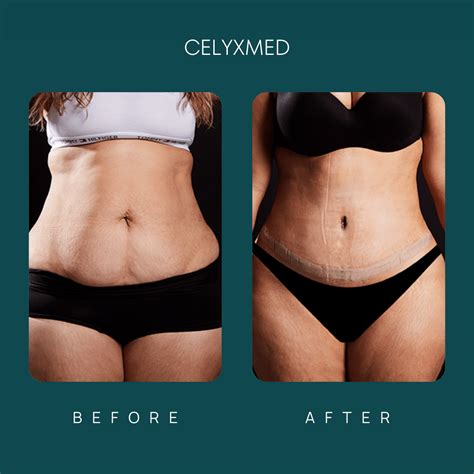 Tummy Tuck In Turkey All Included 3 175 Celyxmed