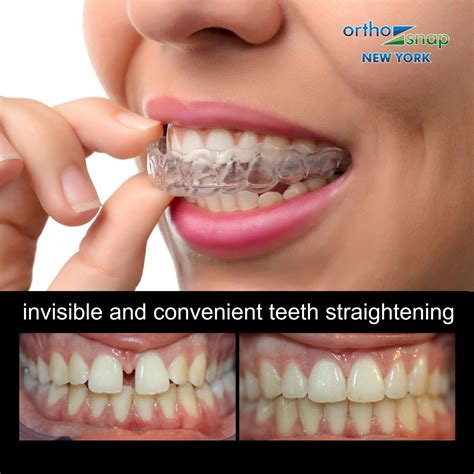 Get Straight Teeth Without Metal Braces OrthoSnap As Effective As