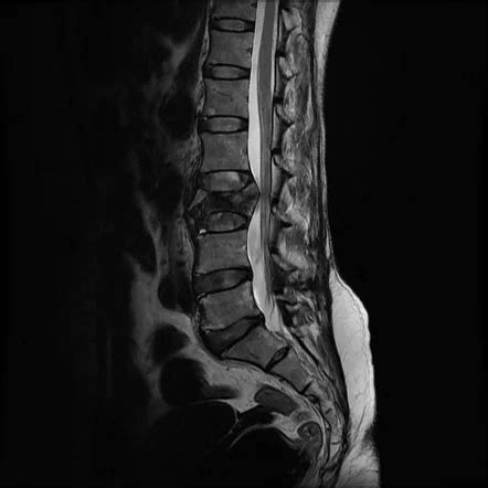 Lumbar Spine Fracture - Cause, Symptoms, Treatment - Samarpan