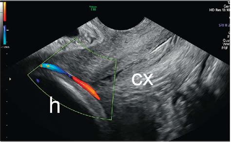 Transvaginal Ultrasonogram With Color Doppler Showing A Fetal Vessel