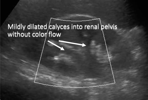 Ultrasound Guide Mild Hydro