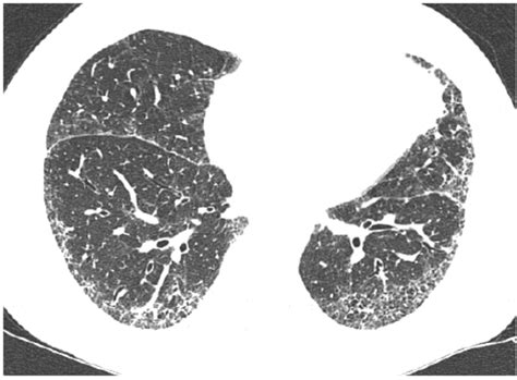 Typical High Resolution Computed Tomography Hrct Image Of Idiopathic