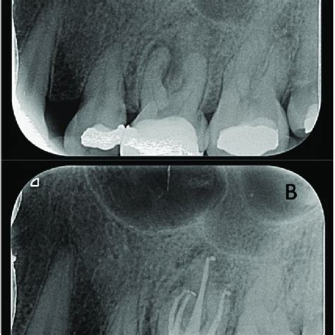 Mb2 Root Canal Location In A Right Maxillary First Molar Using Cbct