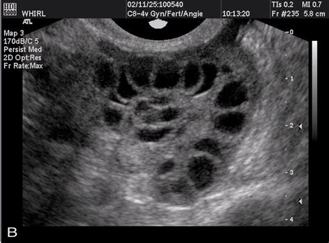 Normal Ovary Transvaginal Ultrasound