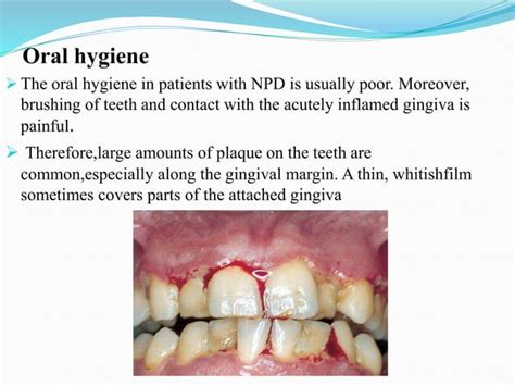 Necrotizing periodontal diseases by Dr Rinky Tripathi pg 2nd year ...