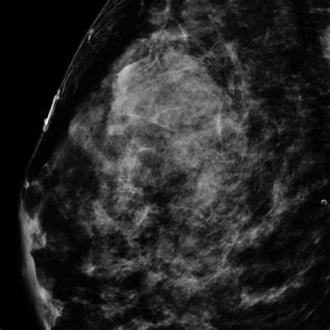 Molecular Breast Imaging With Cc And Mlo Views Of Bilateral Breasts