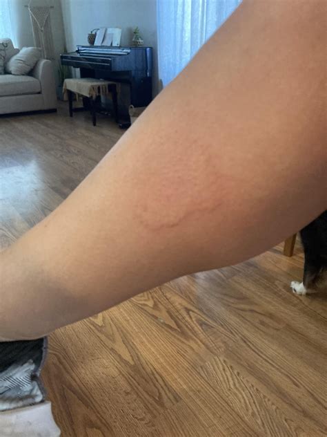 Coldurticaria