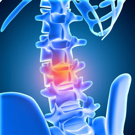 Resecci N De Tumores De La Columna Vertebral Dr David Salda A Alcal