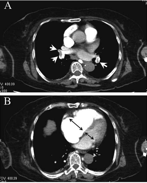 CT Angiography Of The Chest A Filling Defects In The Right And Left