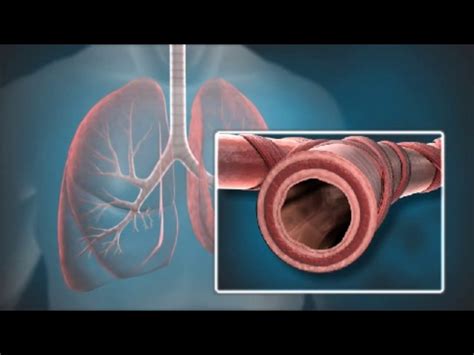 Bronchial Thermoplasty for Severe Asthma | Froedtert & MCW