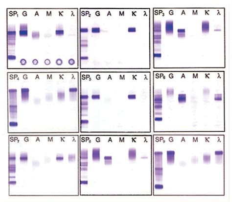 Immunofixation Electrophoresis For Identification Of