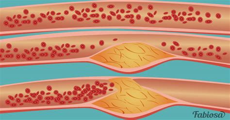 Todo Sobre La Aterosclerosis Riesgos Síntomas Y Prevención Via Ritmo