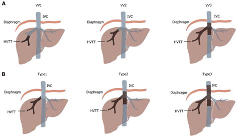 Hepatic Vein Inferior Vena Cava