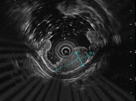 Endoscopic Submucosal Dissection Of A Gastric Gist A A Gastric Gist