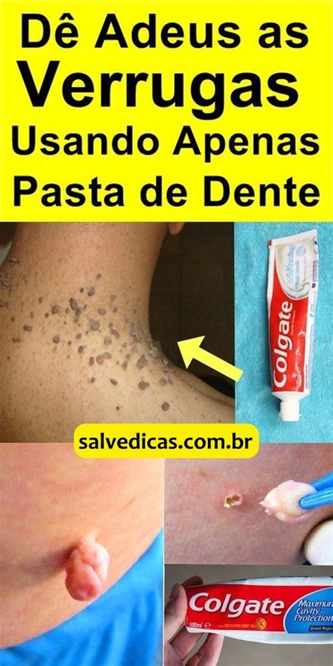 Use A Pasta De Dente Desta Maneira Para Remover Verrugas Health And