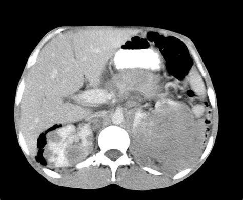 Lymphoma Radiology Reference Article