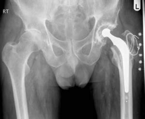 Anterior Vs Posterior Hip Replacement David Slattery