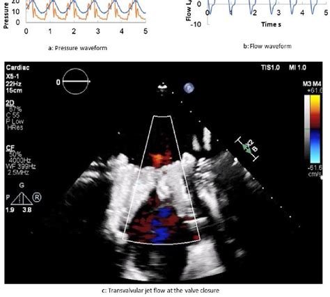 Figure From A Tissue Hybrid Right Ventricular Pulsatile Circulatory