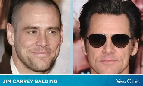 Jim Carrey Balding Journey And Iconic Hairstyles