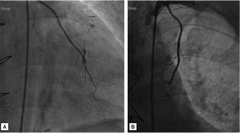 (A) Following coronary artery bypass graft, follow-up coronary... | Download Scientific Diagram