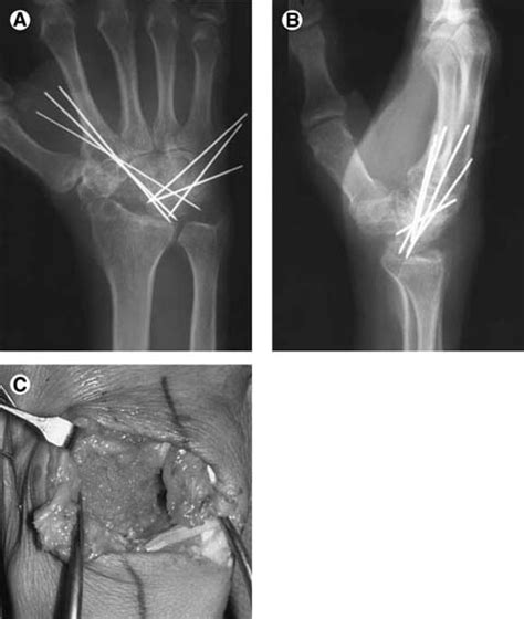 Four Corner Arthrodesis Journal Of The American Society For Surgery